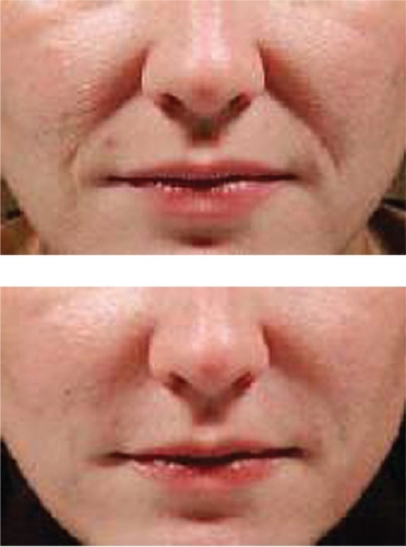 Figure 6 A clinical example of the use of Juvederm™ for nasolabial folds.