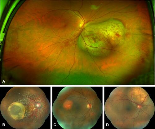 Figure 1 (A) Ultra-wide field fundus image of a single lesion, bi-lobulated, dome-shape choroidal metastasis from lung cancer, with intraretinal microhemorrhages over and around the tumor, as well as subretinal fluid in the lower retina quadrants. (B) Choroidal metastasis from breast cancer with multiple, disseminated seeds and a large cystoid subretinal fluid accumulation. (C) Renal cancer metastasis, reddish-orange, slightly elevated and round tumor. (D) Solitary, white-yellowish lesion from pulmonary cancer with subretinal fluid around the metastasis.