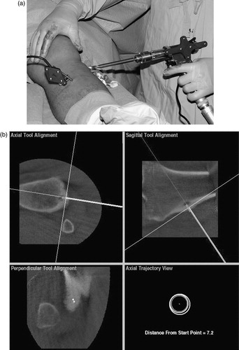 Figure 7. (a) Percutaneous navigated drilling of the proximal tibial lesion with a hollow drill. (b) Intraoperative navigation screen in three multiplanar reconstructions. The actual position of the drill (green) is shown in reference to the good visible lesion on the tibia shaft. An aiming device helps to drill along the planned trajectories (red) and shows the distance from the start point. [Color version available online]