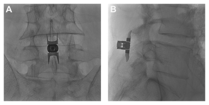 Figure 1 (A) Postero-anterior and (B) lateral radiographic images showing a properly placed Superion® Interspinous Spacer (VertiFlex, Inc, San Clemente, CA).