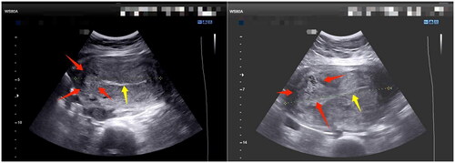 Figure 3. The inhomogeneous mass in lateral upper angle of uterine cavity after delivery. The red arrows showed the mass and it may be created by a decrease in the area of the placental implantation site. The yellow arrow showed the endometrium line.