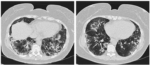 Figure 1. HRCT at debut. A NSIP pattern with consolidations, sub-pleural sparing and ground glass opacities in a perilobular localisation are seen in the basal lung zones.