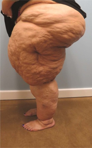 Figure 1 A 43-year-old woman with long-standing lipedema.