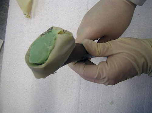 Figure 3. The antibiotic-loaded bone cement, consisting of the same mixture as the spacer, is introduced into the glove.