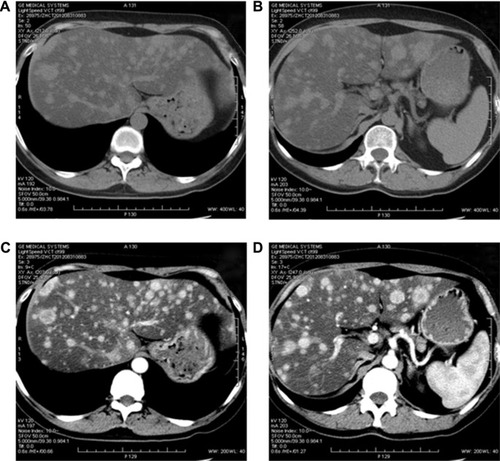 Figure 1 CT image of the patient with hepatic metastasis in September 2012, 70 months after the initial surgical treatment.