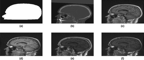 Figure 1. Binary mask (a), CT image (b) and MR images (c)–(f).
