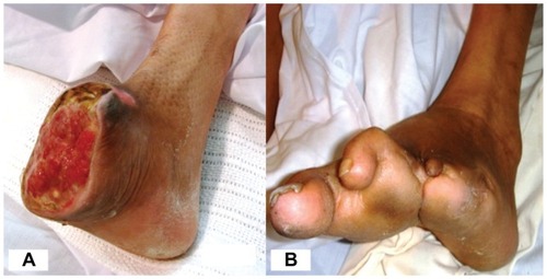 Figure 3 Case 2, right foot stump with good granulation tissue 10 days post bypass A). The left foot with previous toes amputation B).