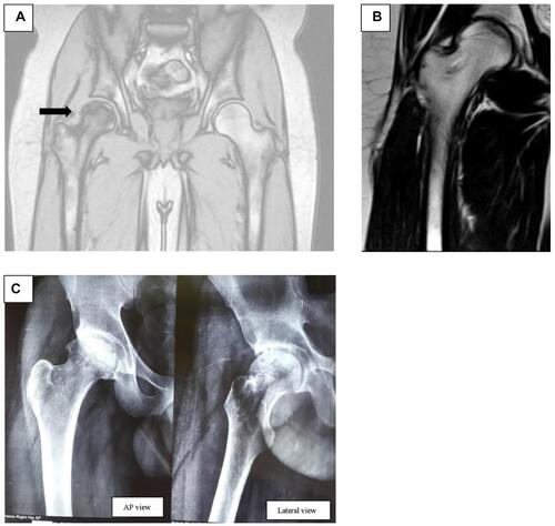 Figure 5 Pre- and posttransplantation MRI and X-ray images (A): pre-operative MRI – (male patient [35 years]): Ficat and Arlet Stage II B with a subchondral fracture of right hip with a large anterolateral lesion (arrow) involving more than 40% of femoral head and less than 2mm depression at high risk of collapse. Etiology is post steroid AVN. (B) Post-operative MRI at 5 months post-surgery. (C) Post-operative X-ray at 4 years after surgery; anteroposterior (AP) view and lateral view.
