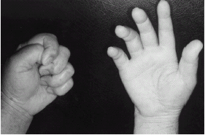 Figure 2. One week after the operation, left hand was normal and right hand could neither be flexed nor extended.