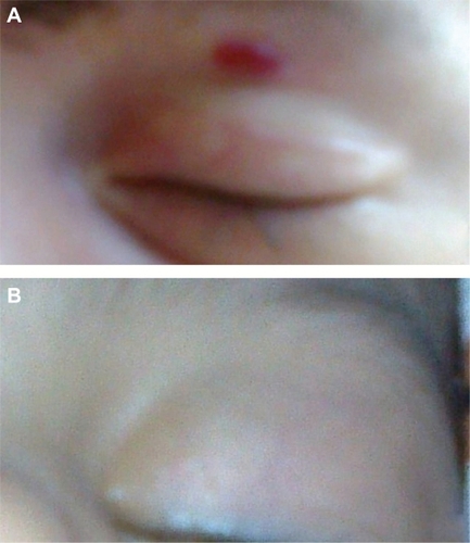 Figure 1 Clinical photographs of a representative case showing a 4-month-old patient with periocular hemangioma. (A) Initial photographs before injection and (B) 4 months after propranolol injection showing excellent response with almost complete resolution of the lesion.