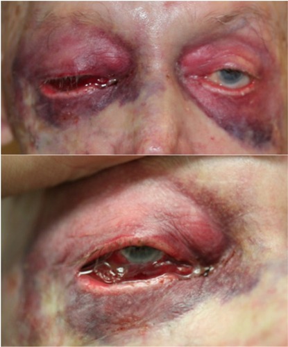 Figure 2 Facial photographs ~20 hours after surgery.