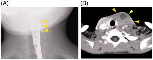 Figure 1. Preoperative images. (A) Contrast radiograph showed a leakage of contrast material on left pyriform sinus. (B) Contrast-enhanced CT after the first open neck surgery showed an abscess of the left anterior neck suspecting recurrence of PSF.