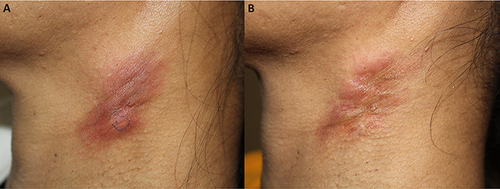 Figure 1 Clinical features and treatment response of SLEP. (A) A solitary firm to hard erythematous plaque mimicking dermatofibrosarcoma protuberans on the left lateral neck. (B) Partial improvement with indentation after treatment with intralesional steroid and hydroxychloroquine (200 mg/day).