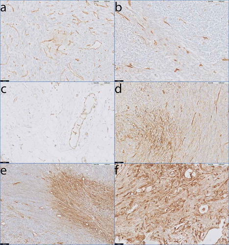 Figure 3. HLA-I expression patterns in monophasic SS.Antibody staining specific for HLA-A and HLAB/C on tumour sections from monophasic SS with endothelial lining of blood vessels as internal positive control. a) SS51 demonstrating low, focal expression of HLA-A. b) SS38 demonstrating low, focal expression of HLA-B/C. c) Healthy loose connective tissue demonstrating low HLA-B/C expression on stromal cells. d) SS35 demonstrating heterogeneous expression of HLA-A. e) SS05 demonstrating heterogeneous expression of HLA-A. f) Small lung metastasis (< 2 mm) demonstrating homogeneous expression of HLA-B/C.Scale bars: a-d, f: 50 µm; e: 100 µm.