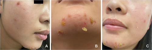 Figure 1 Images of the lesions before treatment (A–C). Image of the lesions on her right cheek (A). Image of the lesions on her chin (B). Image of the lesions on her left cheek (C).