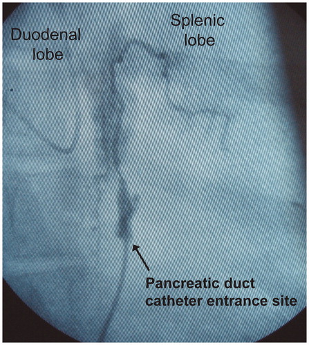 Figure 3. Infusion of contrast medium into the pancreatic duct. The contrast medium fills the entire length of the duct. In the duodenal lobe, acinary filling is observed. In the splenic lobe, the filling of first-generation duct branches is observed. No leakage of contrast medium at the catheter entrance site is observed. The volume of infused contrast medium corresponds to the volume of infused taurocholate.