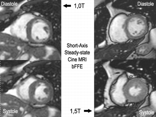 Figure 2. Short axis bFFE systolic and diastolic images comparison for 1.0 and 1.5T scanners.