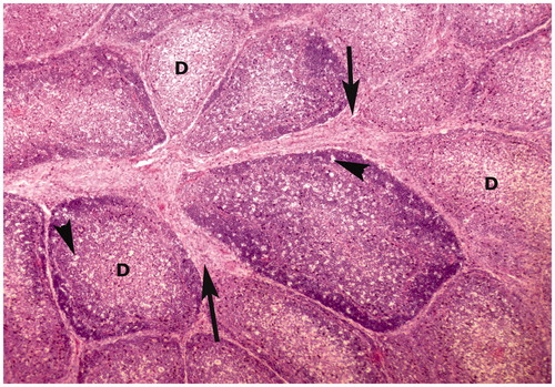 Figure 1. Bursa of Fabricius of broiler chick administered chlorpyrifos (20 mg/kg BW) at post-treatment Day 15. Representative photomicrograph shows vacuolar degeneration (arrow heads), proliferation of fibrous connective tissue between lymphoid follicles (arrows), and follicles depleted from lymphoid tissue (D). H&E stain. Magnification = 200×.