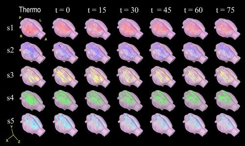 Figure 4 Cerebral volume reconstructions of BOLD activation maps in response to noxious thermonociception and sciatic denervation Cerebral reconstruction in 3D of false colour images of changes in BOLD signal of each subject (subject 1 to 5, in rows), thermal nociception (t = −15), immediate sciatic denervation (t = 0) and post-denervation every 15 minutes (t =15, 30, 45, 60 and 75). The BOLD activation appeared predominantly in the right hemisphere; except for the ACC, which occurred bilaterally. Representative videos for times −15, 0, 30 and 75 min may be accessed in Supplementary materials.