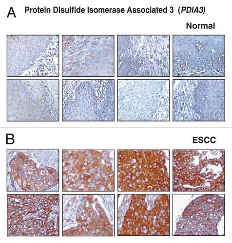 Figure 6 Validation of PDIA3 using immunohistochemical labeling. Expression of PDIA3 in representative normal esophageal squamous mucosa (A). Expression of PDIA3 in ESCC is observed in both stromal and epithelial cell compartments (B).