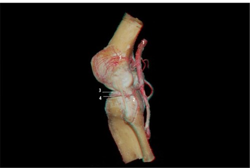 Figure 6 Lateral view of the knee: popliteal artery (1), popliteofibular ligament (2), lateral meniscus (3), lateral inferior genicular artery (4), and lateral superior genicular artery (5).