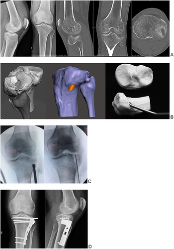 Figure 2 X-ray and CT images showing sinking of the lateral tibial plateau (A); virtual surgical planning and surgical simulation using the 3D printed anatomical model for joint surface elevation (B); intraoperative fluoroscopic image of lateral plateau cartilage elevation (C); outcome of surgical treatment (D).