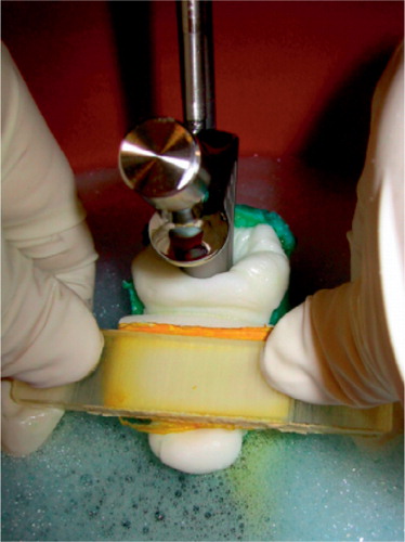 Figure 2. Stem implantation.The broached femur, connected by a five-degrees-of-freedom clamp to the base of a materials testing machine, was surrounded by 37°C blood analogue.The femoral stem was clamped to the crosshead.After the canal had been filled and pressurized, the stem was inserted at a constant displacement rate.The normal clinical practice of occluding the medial side of the canal was simulated safely by using a foam rubber-backed rod in place of a thumb.