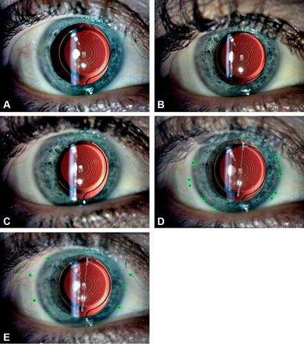 Figure 1 Slit lamp photographs taken at (A) Day 1 (baseline), (B) Month 1 and (C) Month 3. (D) Analyzed picture at Month 1 showing the blue squares that represent the baseline landmarks chosen by examiner while the green squares represent the ones chosen in the Month 1 image. (E) Analyzed picture at Month 3. Good image alignment is shown by the blue and green squares overlapping.