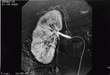 Figure 2. The right renal angiography revealed a hypovascular or avascular lesion in the upper pole of right kidney, measuring about 1 cm in size.