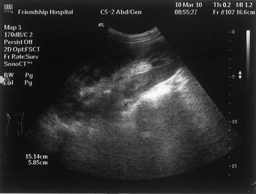 Figure 1. Abdominal ultrasonography revealed notable renomegaly with increased echo, the right kidney taken for example.