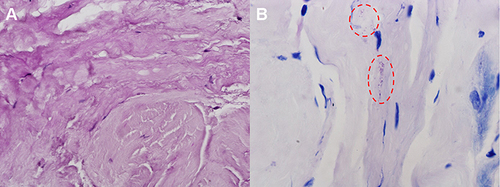 Figure 2 (A) Core biopsy of the right femoral head revealed necrotic material stained with HE. (B) Giemsa staining demonstrated scattered positive Brucella (red circle).