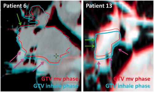 Figure 3. Patient examples illustrating how different parts of the tumor have different respiratory motion patterns leading to tumor deformation between the different respiratory phases. Green arrows indicate areas with small respiratory motion. Pink arrows indicate areas with large respiratory motion.