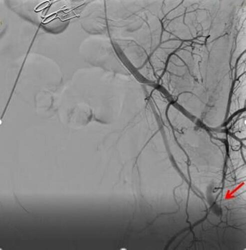 Figure 4 Angiography of the left internal iliac artery by a Bernstein catheter showing a pseudoaneurysm of the gluteal artery (red arrow).
