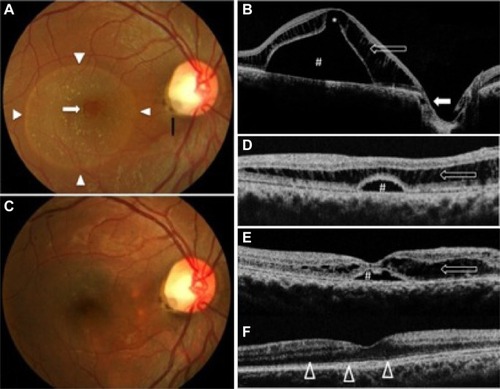 Figure 2 Representative patient, case 17.