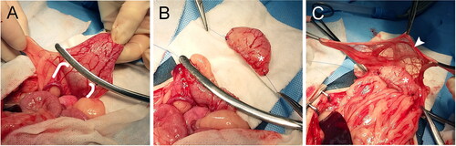 Figure 2. Dogs in Group A underwent a single surgical procedure in order to determine if viability could be achieved with a single procedure. The bladder vesicle was created and omentalized in the same procedure. The body of the urinary bladder was (A) isolated and (B) transected and oversewn. (A) The ureters (outlined in white) and ureterovesicular junctions were left intact draining into the trigone, which was oversewn to allow for continued urination. (C) The oversewn vesicle (asterisk) was then excoriated and wrapped in omentum (white arrowhead) prior to tacking to the body wall.