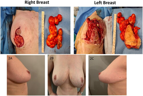 Figure 2. Images of specimens taken intraoperative (1A,1B) and postoperative pictures at 12-month follow-up (2A,2B,2C).