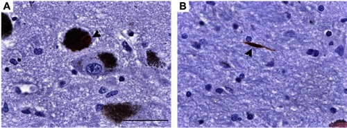 Figure S1 S129 phosphorylated α-syn in a sample of brain from a human PD patient. (A and B) Representative photomicrographs at 63×  of p-α-syn-ir in human PD brain in (A) a neuromelanin laden neuron and (B) a neurite. Scale bar =50 μm.Abbreviations: p-α-syn-ir, S129 phosphorylated alpha-synuclein- immunoreactivity; PD, Parkinson’s disease.