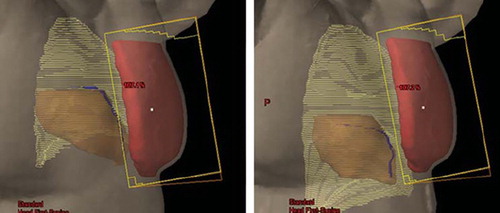 Figure 3. Beam's eye views of the medial tangential field during free breathing (left) and deep inspiration breath-hold (right) for a typical patient. During inspiration the lung volume (light yellow) is increased, the breast (red) is moved cranioventrally and the heart (brown) caudally. In the shown case, the heart and the LAD coronary artery (blue) were not included in the beam portal (yellow lines) during DIBH.