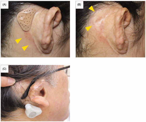 Figure 5. Mild dermatitis around the adhesive adapter and inappropriate position of the device. Mild dermatitis around the adhesive adapter was observed in subject ACU1. The erythema is observed only in the surrounding area and not directly under the area of contact with the adapter (A, B). Subject ACB2 placed the adapter on the lower mastoid area so he could not obtain sufficient gain from the device due to sound transmission attenuation by the soft tissues.