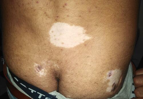 Figure 3 Vitiligo in a patient with Vogt–Koyanagi–Harada syndrome.