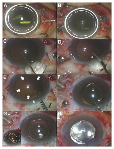 Figure 1 (A–H) Intraoperative photographs. (A) Lens nucleus is crushed using a microvitreoretinal blade and a 20-gauge needle. (B) Lens material is removed using vitreous cutter. Care is taken not to damage the anterior capsule. (C) Viscoelastic material is injected into the anterior chamber through a 2.8 mm superior clear corneal incision. (D) A puncture is made on the remaining anterior capsule using a bent needle. (E) Continuous curvilinear capsulorhexis is being done on the anterior capsule. White arrows indicate the margin of the capsulorhexis being made. (F) An IOL is placed in the ciliary sulcus initially, then the IOL optic is captured through the capsulorhexis. (G) The successfully captured IOL makes an oval capsulorhexis margin. Inset: A graphic illustration of the shape of the capsulorhexis margin (green line) and the position of the haptics (purple lines). (H) The captured IOL-capsule diaphragm maintains stability during fluid–air exchange.