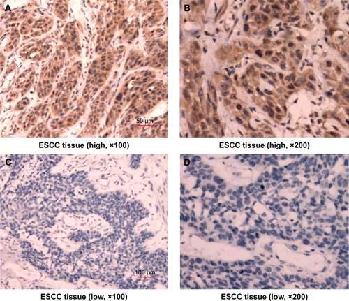 Figure 1 Immunostaining demonstrating the expression of ARHI in ESCC tissues.