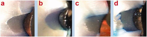Figure 3. Representative stereomicroscopic images; a: no microleakage was detected (score 0, b: microleakage into the enamel portion of the cavity was detected (score 1), c: microleakage to the dentinal portion of the cavity without axial wall penetration was detected (score 2), d: microleakage into pulpal floor of the cavity was detected (score 3).