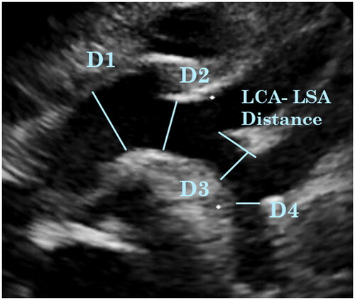 Figure 1. Sites of measurements of the aortic Arch.