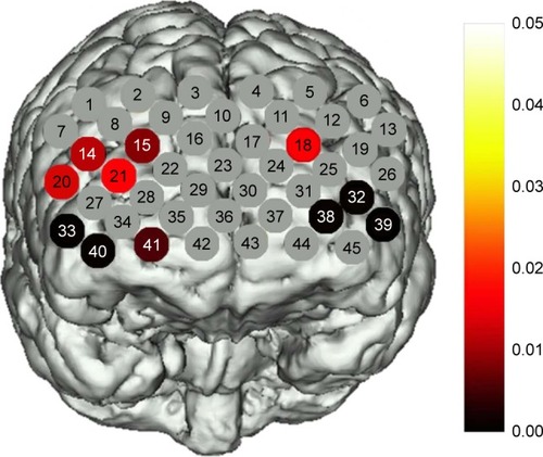 Figure 3 A map showing statistically significant lower oxy-Hb changes in BDp patients compared with the controls during the VFT.