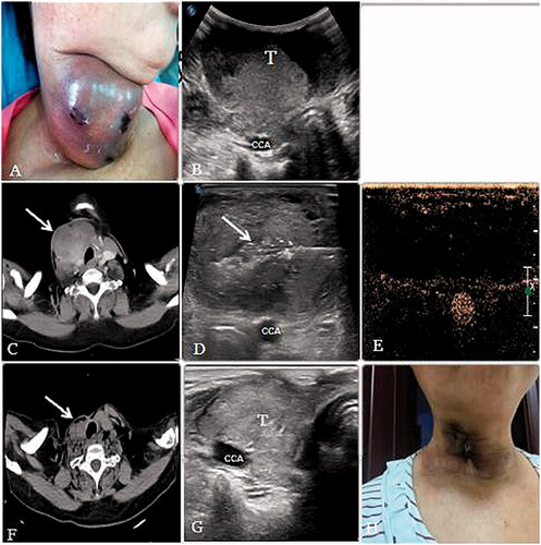 Figure 2. (A, B) A 57-year-old woman had a thyroid papillary carcinomas’ postoperative metastasis to the cervical lymph nodes.A huge mass could be seen in the neck and the lesion is adjacent to the common carotid artery (CCA). (C) Before MWA, axial contrast-enhanced CT scan demonstrated a large tumor (arrow) was located in the right neck of the patient and the airway is compressed. (D) During the procedure, multiple echogenic microbubbles (arrow) around the antenna tip were noted. (E) After MWA, CEUS showed that most of the lesion was inactivated and showed no enhancement. (F) After 8 months, axial CT scan demonstrated that the lesion volume decreased significantly and the airway compression recovered. (G) After 8 months, the volume of the lesion decreased from 139.47 cm3 to 14.01 cm3. (arrow). (H) The lesion almost could not be seen and only a scar and some pigmentation were left on the neck.