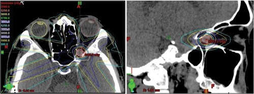 Figure 4 On treatment planning for fractionated stereotactic radiotherapy, a GTV of 0.3 cm3 was determined by CT and MRI.