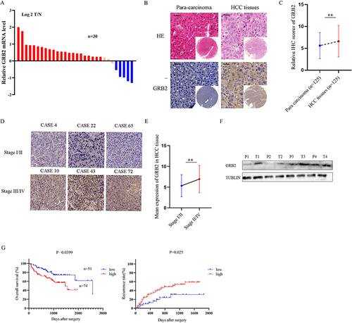 Figure 12 GRB2 was up-regulated in HCC tissues: (A) GRB2 mRNA expression levels were verified by qRT-PCR, and the results were expressed as Log2(T/N). (B) Representative image of TMA with anti-GRB2 chemical staining (C) Relative HCC scores of GRB2. (D) Expression of GRB2 in HCC tissues of different stages. (E) Mean expression of GRB2 in 125 HCC tissues. (F) GRB2 protein levels in 4 pairs of HCC frozen tissues and their corresponding paracancerous tissues. (G) The overall survival rate and disease-free curve of 125 patients were divided into high expression group and low expression group. **P < 0.01.