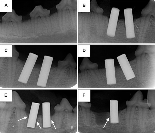 Figure 4 X-ray radiographs.Notes: (A) The mandible third premolars before extraction, (B) implants after implantation immediately, (C) experimental group after 2-month implantation, (D) positive control group after 2-month implantation, and (E) and (F) blank control group after 2-month implantation. The arrows show the shadow around the implants.