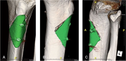 Figure 5. 3D rendered images made with iNtution (TeraRecon). The allograft is auto-segmented and colored green. The medial view shows the defect caused by an angulation misalignment in the last stage of the proximal resection plane. A. Medial view. 2 distinct resection cuts are visible. B. Anterior-posterior view. C. Lateral view.